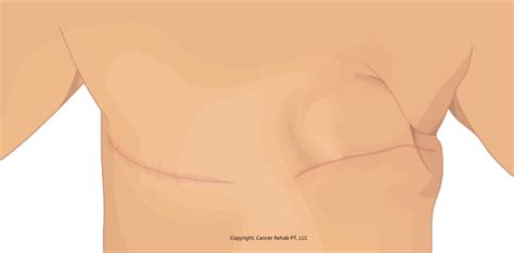 Mastectomy Onlyfans Leak