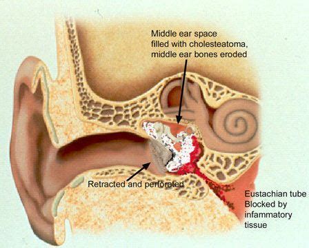 Mastoïdectomie: Procedure, Complicaties, en Outlook