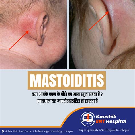 Mastoiditis