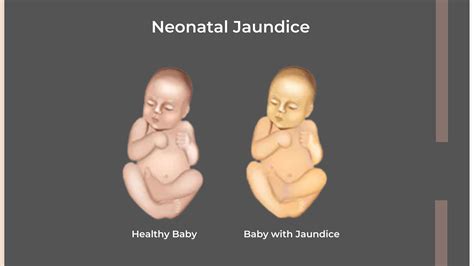 Maternal disease factors associated with neonatal jaundice: a …