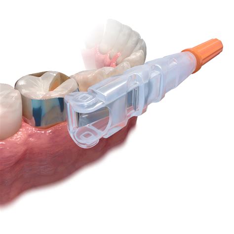 Matrixen - Matrix - OrangeService Dental