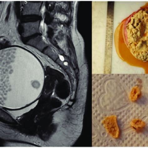 Mature Teratoma - an overview ScienceDirect Topics