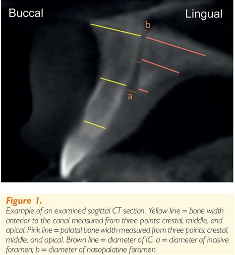 Maxillary Incisive Canal Characteristics: A Radiographic Study …