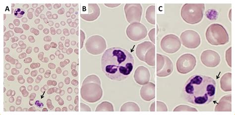 May-Hegglin Anomaly