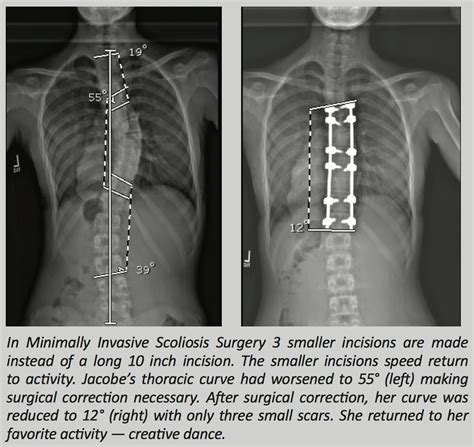 Mayo Clinic Minute: Correcting the curve with scoliosis surgery