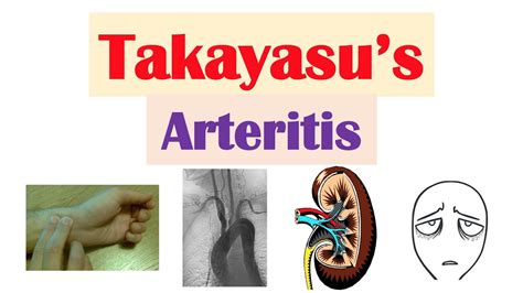 Mayo Clinic Minute: What is Takayasu’s arteritis?