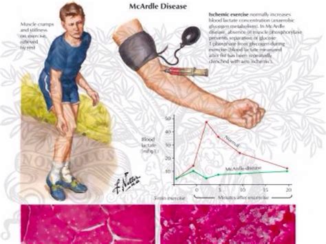 Mcardles - McArdle disease (also known as glycogen storage disease type V) is a pure myopathy caused by an inherited deficit of myophosphorylase, the skeletal muscle isoform of the enzyme glycogen phosphorylase.
