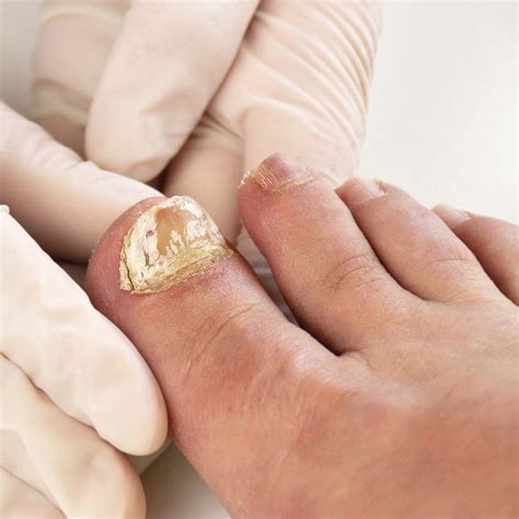 Meaning of white toenails. Yellow nail syndrome is a rare condition that affects the fingernails and toenails. People who develop this condition also have respiratory problems and lymphatic system problems with swelling in ... 