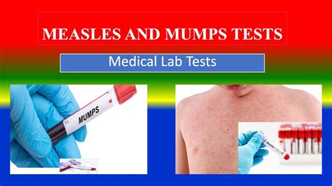 Measles and Mumps Tests: MedlinePlus Medical Test