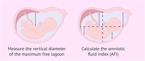 Measurement of amniotic fluid quantity