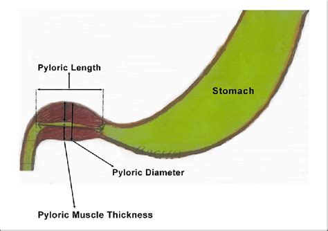 Measurement of the diameter of the pylorus in man - ScienceDirect