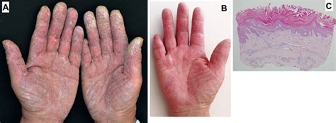 Mechanic’s hands lesions in antisynthetase syndrome