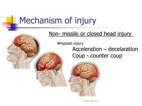 Mechanism of Injury 1 - Wiley