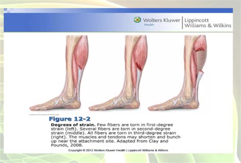 Med surg musculoskeletal quizlet. ANS: C The epiphysis is the widened area at each end of a long bone, and the proximal tibial epiphysis is the upper end of the lower leg, just below the knee. The thigh bone is the femur. Mid-calf area includes the diaphysis (shaft) of the tibia and fibula. Toe bones are phalanges. Study with Quizlet and memorize flashcards containing terms ... 
