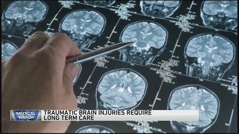 MedWatch Daily Digest: Study spanning 25 years shows effects of traumatic brain injuries