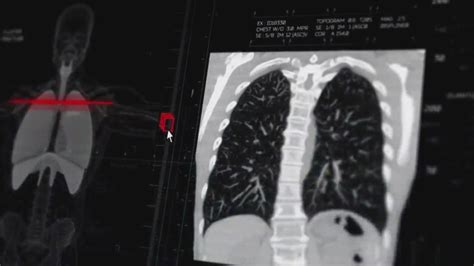 MedWatch Digest: Illinois ranks 16th worst in lung rates for 2023 — and more