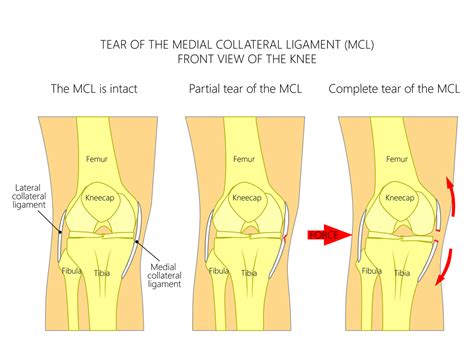 Medial Collateral Ligament (MCL) Sprain Non-Operative Protocol