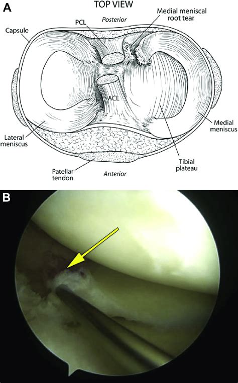 Medial meniscus posterior root tear: a comprehensive review