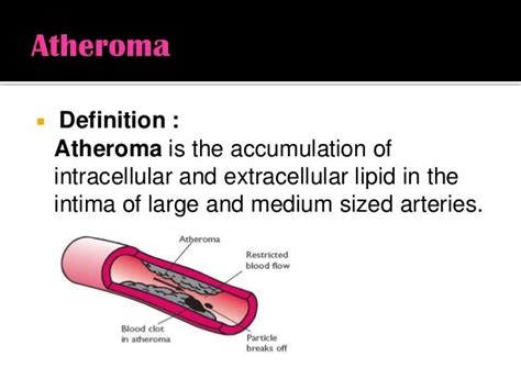 Medical Definition of Atheroma - MedicineNet