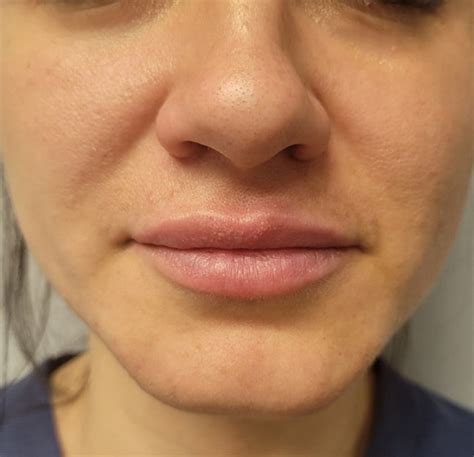 Medical Spa Burlington Vermont Lip Injections