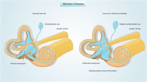 Medical medium menieres disease. .  ...