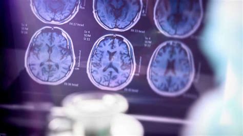 Medicare will remove limits on PET scans used with new Alzheimer's drugs