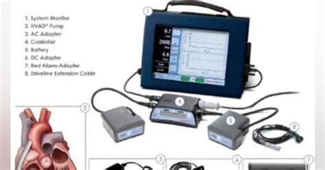 Medtronic recall of HeartWare HVAD batteries is Class I