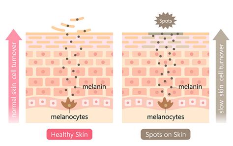 6 cara merawat dan menghilangkan keloid atau