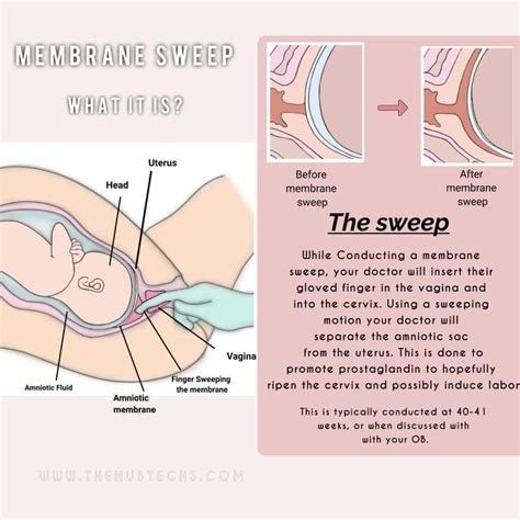 Membrane sweep effectiveness.  Learn about how it works and its effectivene...