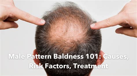 Men’s Hair Loss: Male Pattern Baldness and Other Causes - WebMD