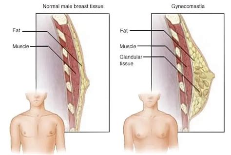 Men that have female breasts. .  <a href=https://empower-health-cms.cierra.dev/assets/images/9c...