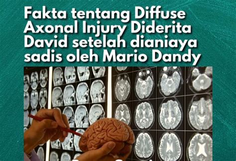 Mengenal Diffuse Axonal Injury, Cedera Otak yang Dialami David …