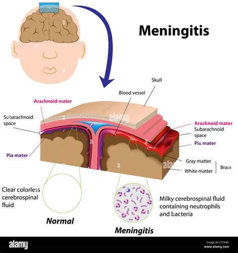 Meningitis 뜻