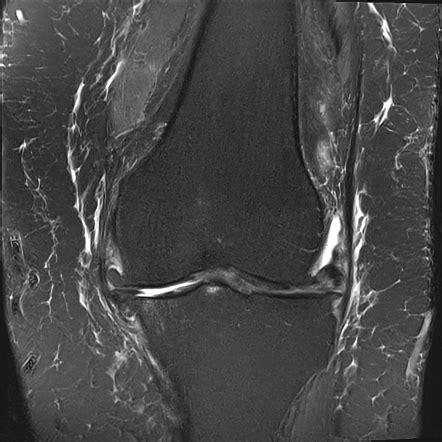 Meniscal maceration Radiology Reference Article