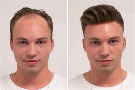 Mens hair replacement. There are two main kinds of hair transplants available: follicular unit transplantation (FUT) and follicular unit excision (FUE). While other techniques exist – including stem … 