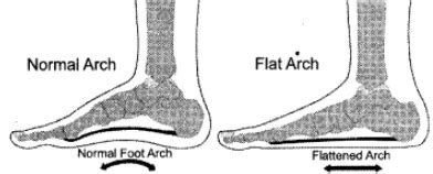 Mention the causes and corrective measures for the Flat Foot