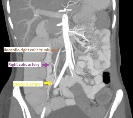 An urgent CT abdominal angiogram taken in February 2021 showed a pseudoaneurysm arising from a terminal branch of SMA in the right iliac fossa, further suggesting an increase in size from 37 mm x 50 mm (anteroposterior [AP] × transverse [TV]) to 47 mm x 53 mm in maximum axial diameter since last CT scan and concluded as ….