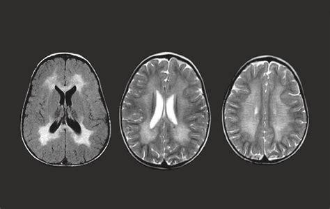 Metachromatic leukodystrophy