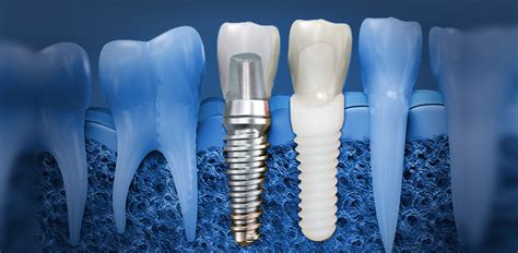 Metal release from ceramic coatings for dental implants