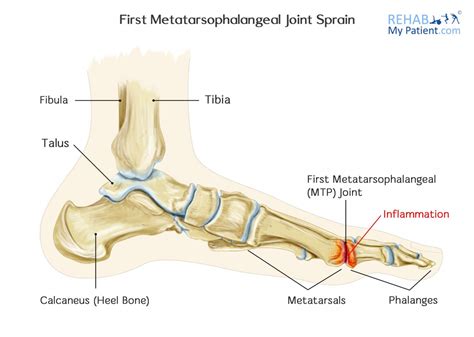 Metatarsophalangeal & Interphalangeal Goniometry