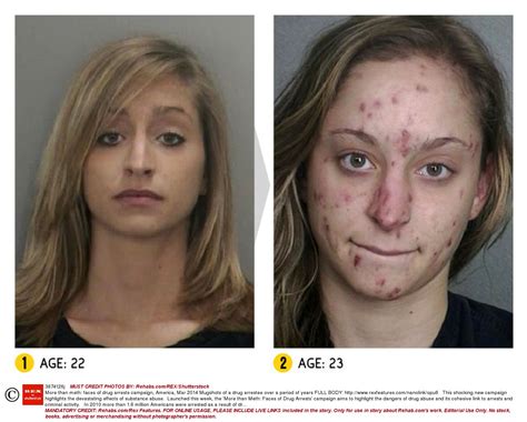 Faces of Meth: Before and After Photos Here are some faces of meth addiction: Faces of Meth: Before and After Photo 1 Source: Addiction Center. This meth user had an extremely drastic change in appearance within the same year. In particular, she started to develop skin problems. Her eyes looked sunken. She also looked distracted.