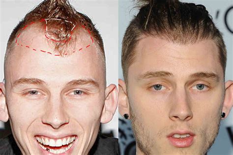 Mgk hair transplant. You can check out Machine Gun Kelly and Loris Karius they had transplants and they have long hair now (MGK has shorter hair now but if you look at pictures from a year ago they were pretty long) also Matthew McConaughey but all of them just had their temples filled. Thank you! I’ll check em out and see 🤘🏼. If the number of grafts … 