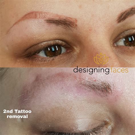 Microblading removal near me. ... Removal. home; Tattoo Removal. Tattoo removal brows ... Additionally, we also offer microblading removal for those who have had. ... me as comfortable and calm ... 