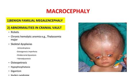 Microcephaly and Macrocephaly - PCH