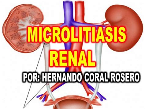 Microlitiasis renal derecha no obstructiva.  Aun as&iacute;, son importantes tus antecedentes m&ea...
