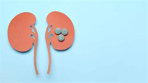 Microlitiasis renal derecha no obstructiva.  Esta enfermedad se considera...