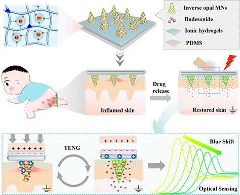 Microneedles as a momentous platform for psoriasis therapy and …