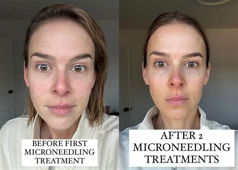 Microneedling to get rid of microblading.  A wide range of color-correcting...