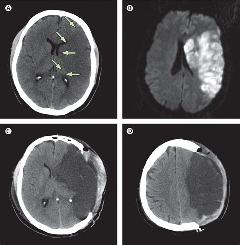 Middle cerebral artery infarction: clinical and radiological …