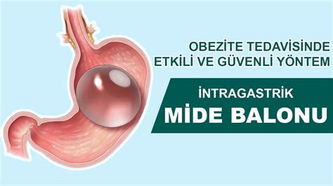 Mide Balonu - Medical in Türkiye